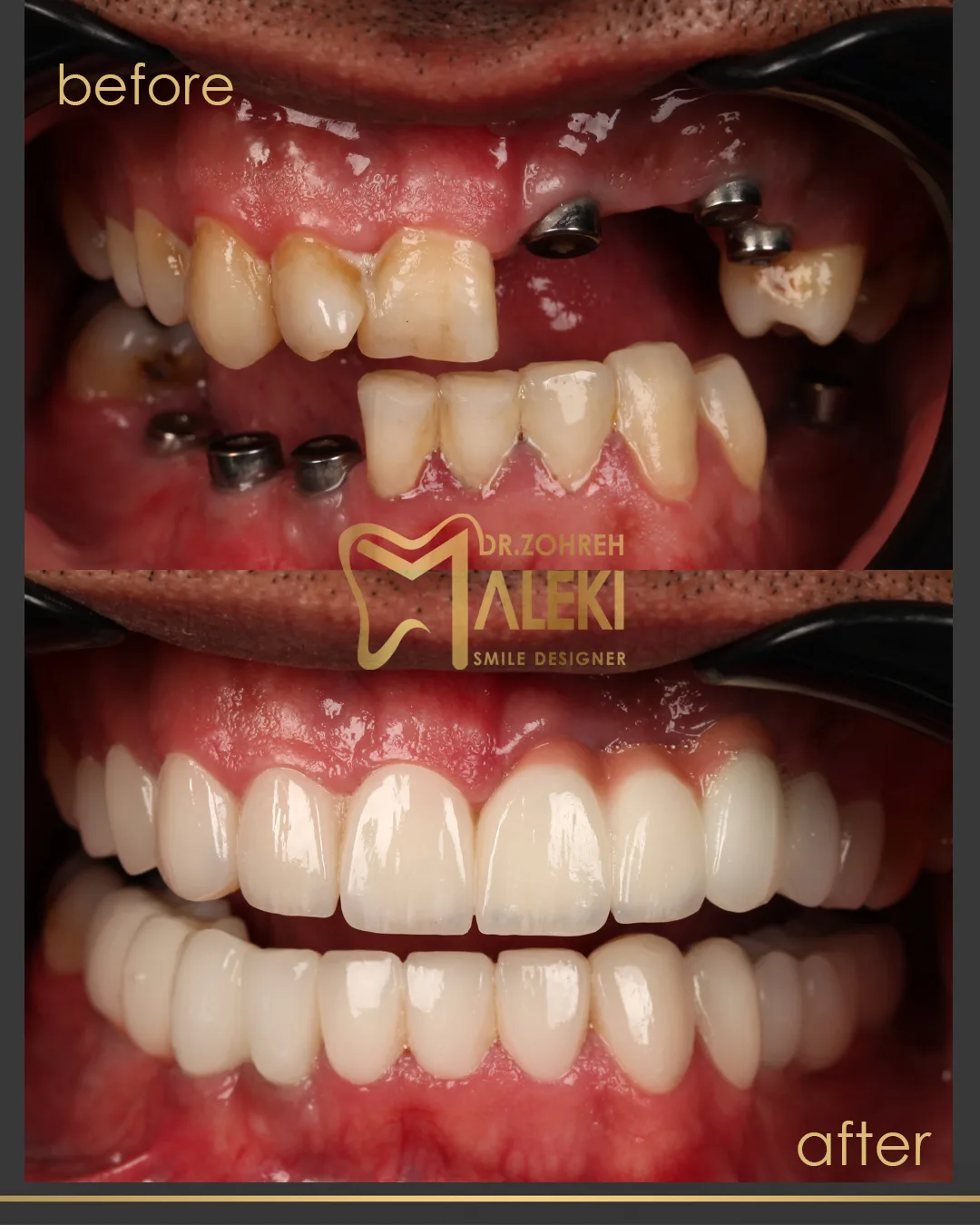 implant2.jpg